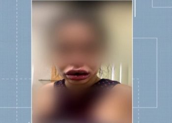 dentista de Campos dos Goytacazes, no Norte Fluminense, está sendo acusada por pacientes de deformar rostos após procedimentos de harmonização facial