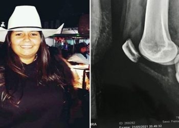 Uma estudante de medicina veterinária, de 27 anos, precisou amputar uma das pernas após ser prensada contra uma cerca por um boi de mais de 600 quilos no sítio em que mora, em Sorocaba
